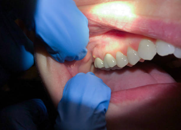 Best Emergency Treatment for Dental Infections or Abscesses in Stone Ridge, VA