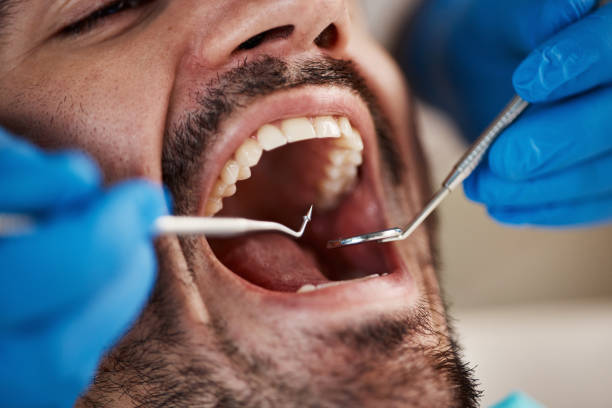 Best Emergency Dental Care for Broken or Chipped Teeth in Stone Ridge, VA